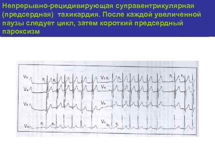 Суправентрикулярная тахикардия карта вызова смп