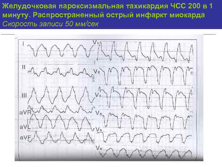 Пароксизмальная тахикардия карта вызова скорой медицинской помощи
