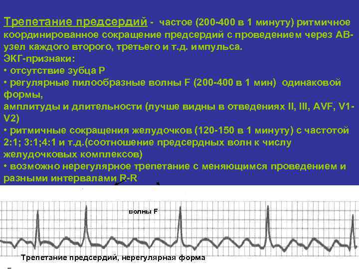 Трепетание предсердий - частое (200 -400 в 1 минуту) ритмичное координированное сокращение предсердий с