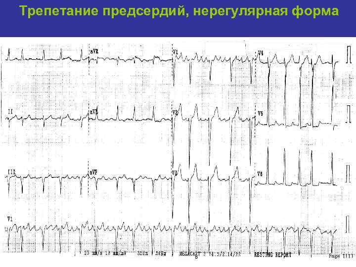 Трепетание предсердий, нерегулярная форма 