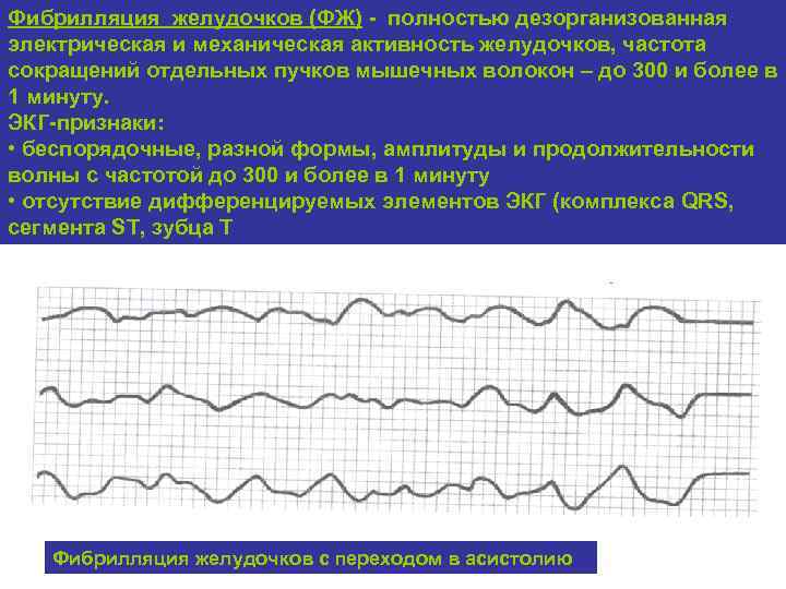 Фибрилляция желудочков (ФЖ) - полностью дезорганизованная электрическая и механическая активность желудочков, частота сокращений отдельных