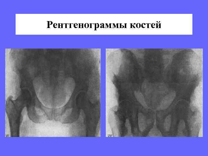 Рентгенограммы костей 