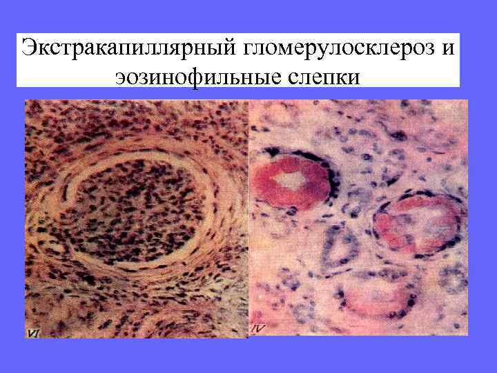 Экстракапиллярный гломерулосклероз и эозинофильные слепки 