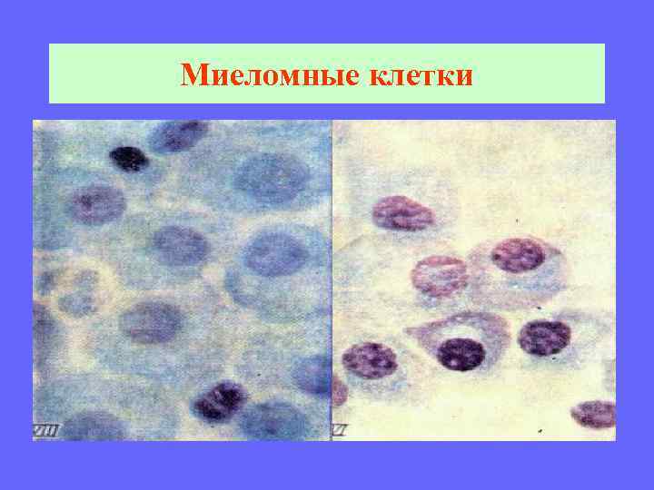 Миеломные клетки 