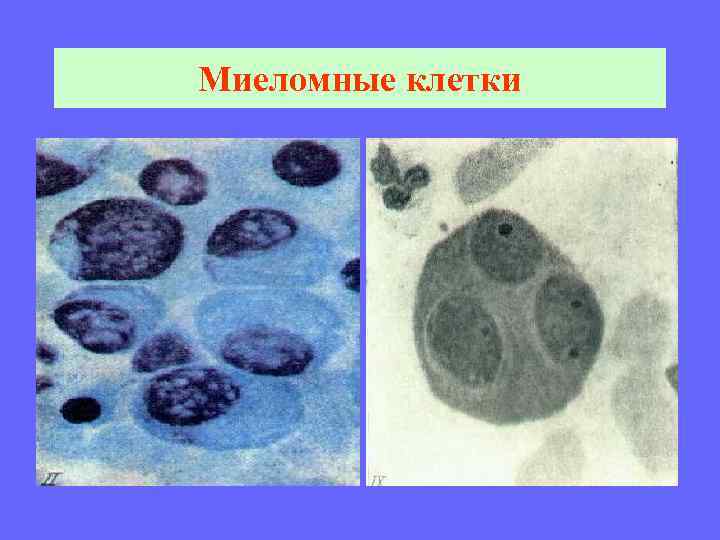 Миеломные клетки 