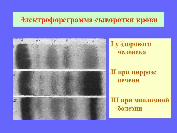 Электрофореграмма сыворотки крови I у здорового человека II при циррозе печени III при миеломной