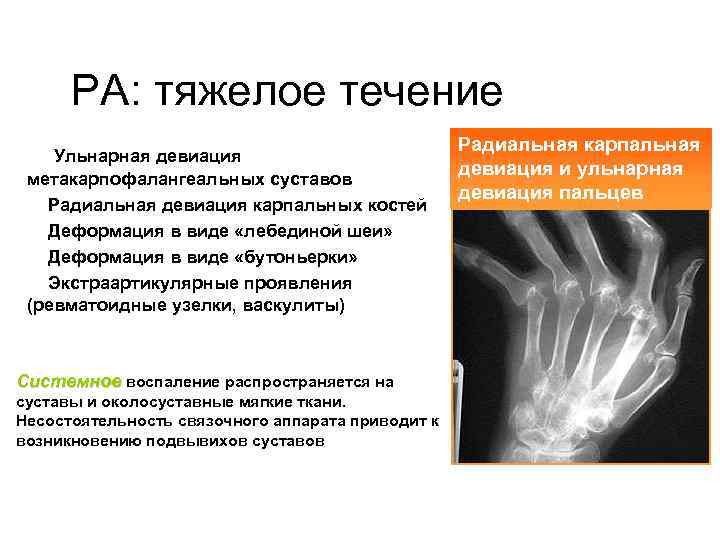 РА: тяжелое течение • Ульнарная девиация метакарпофалангеальных суставов • Радиальная девиация карпальных костей •