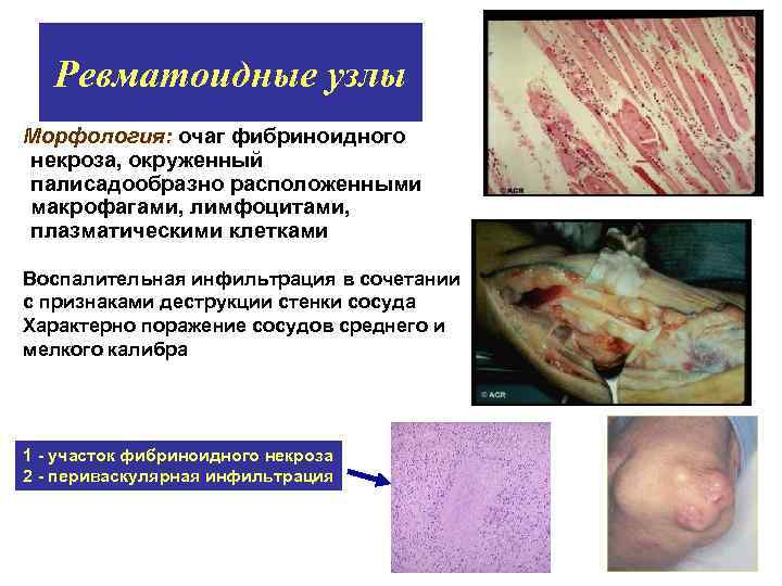 Ревматоидные узлы Морфология: очаг фибриноидного некроза, окруженный палисадообразно расположенными макрофагами, лимфоцитами, плазматическими клетками Воспалительная