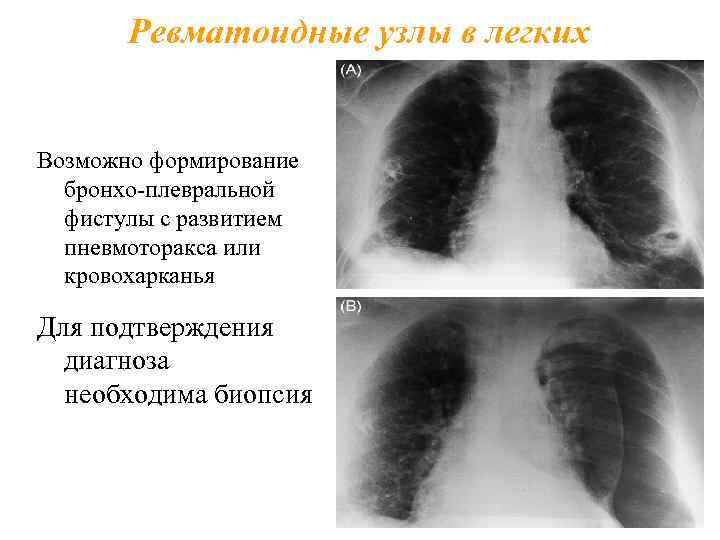 Ревматоидные узлы в легких Возможно формирование бронхо-плевральной фистулы с развитием пневмоторакса или кровохарканья Для