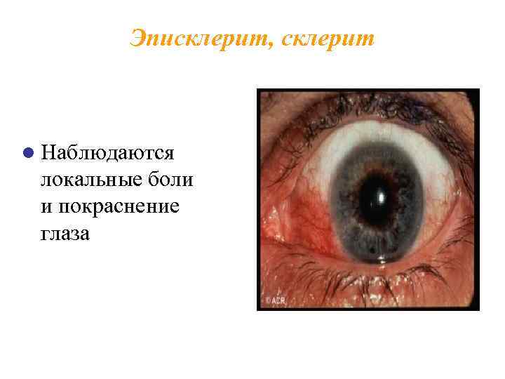 Эписклерит, склерит l Наблюдаются локальные боли и покраснение глаза 