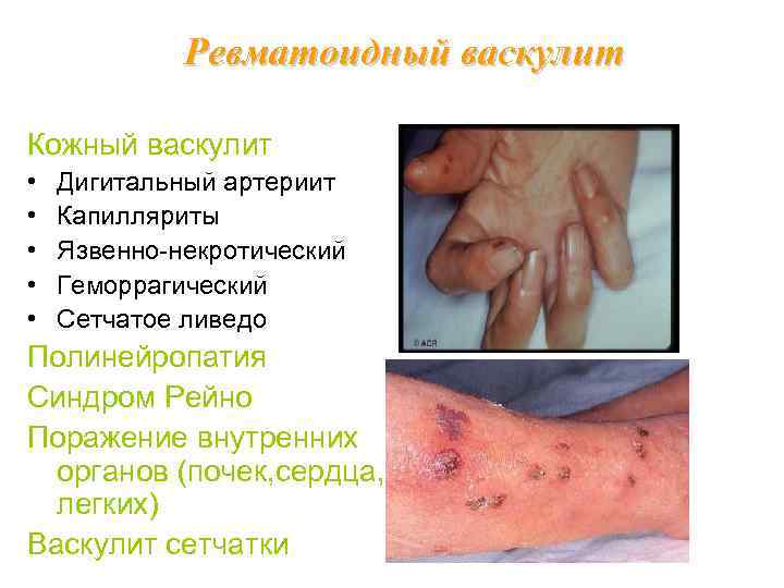 Ревматоидный васкулит Кожный васкулит • • • Дигитальный артериит Капилляриты Язвенно-некротический Геморрагический Сетчатое ливедо