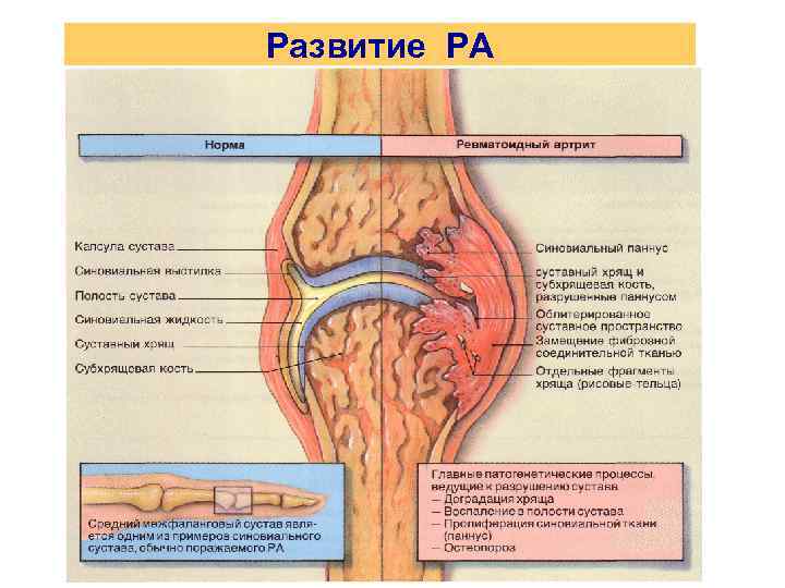 Развитие РА 