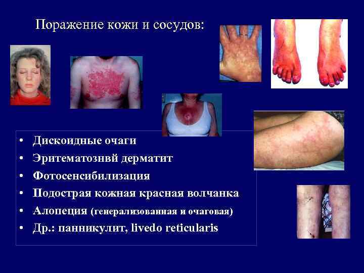 Поражение кожи и сосудов: • • • Дискоидные очаги Эритематознвй дерматит Фотосенсибилизация Подострая кожная