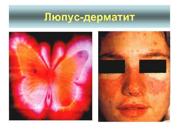Люпус-дерматит 
