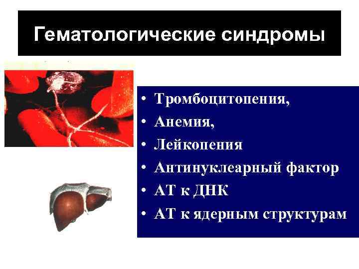 Гематологические синдромы • • • Тромбоцитопения, Анемия, Лейкопения Антинуклеарный фактор АТ к ДНК АТ