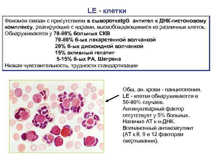 LE - клетки Феномен связан с присутствием в сыворотке. Ig. G антител к ДНК-гистоновому