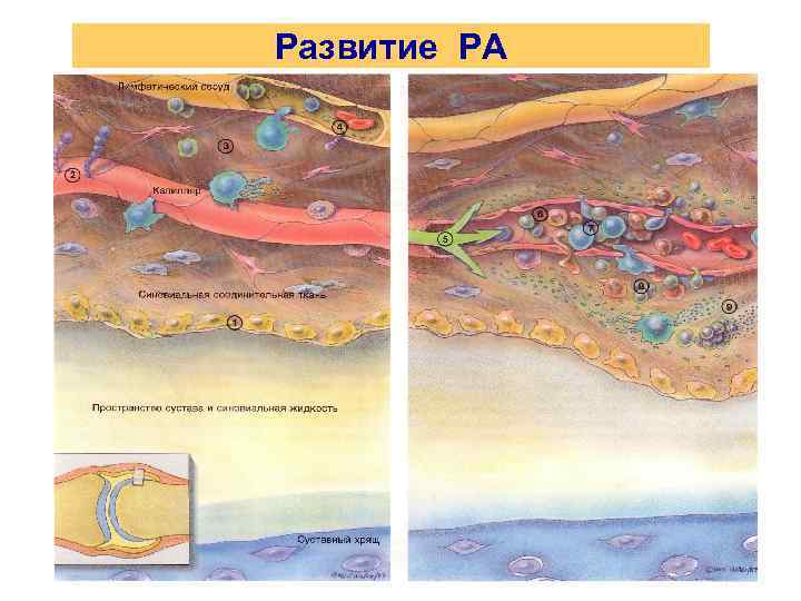 Развитие РА 