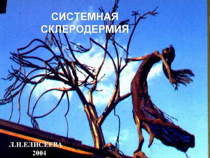 СИСТЕМНАЯ СКЛЕРОДЕРМИЯ Л. Н. ЕЛИСЕЕВА 2004 