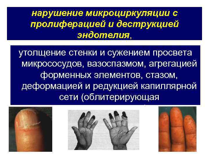 нарушение микроциркуляции с пролиферацией и деструкцией эндотелия, утолщение стенки и сужением просвета микрососудов, вазоспазмом,