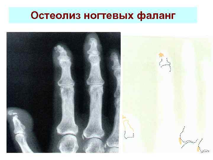 Остеолиз ногтевых фаланг 