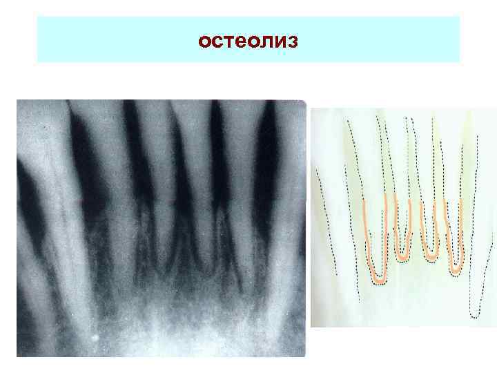 остеолиз 