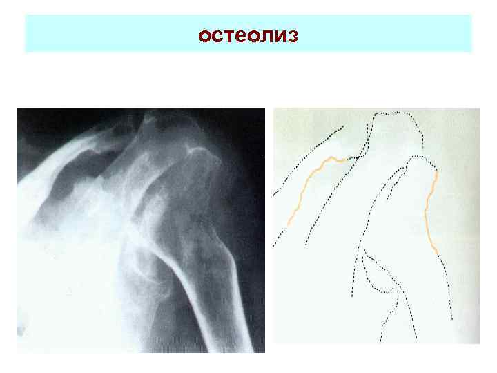 остеолиз 