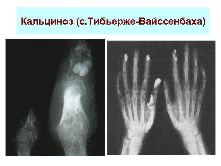 Кальциноз (с. Тибьерже-Вайссенбаха) 