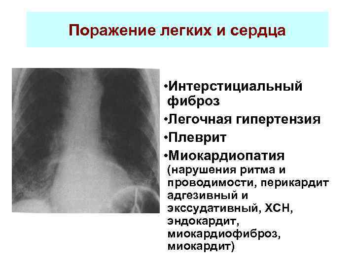 Поражение легких и сердца • Интерстициальный фиброз • Легочная гипертензия • Плеврит • Миокардиопатия