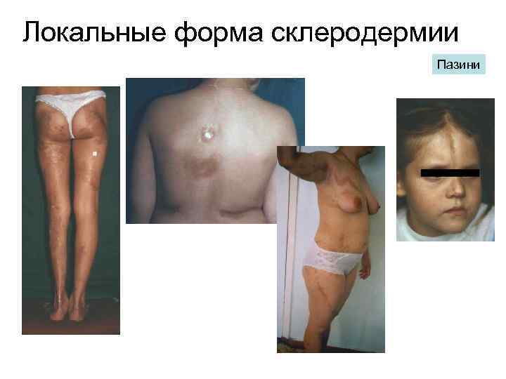 Локальные форма склеродермии Пазини 