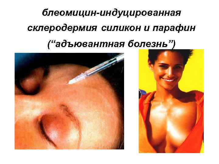 блеомицин-индуцированная склеродермия силикон и парафин (“адъювантная болезнь”) 