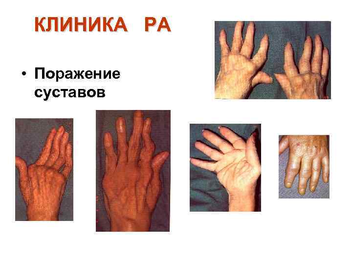 КЛИНИКА РА • Поражение суставов 