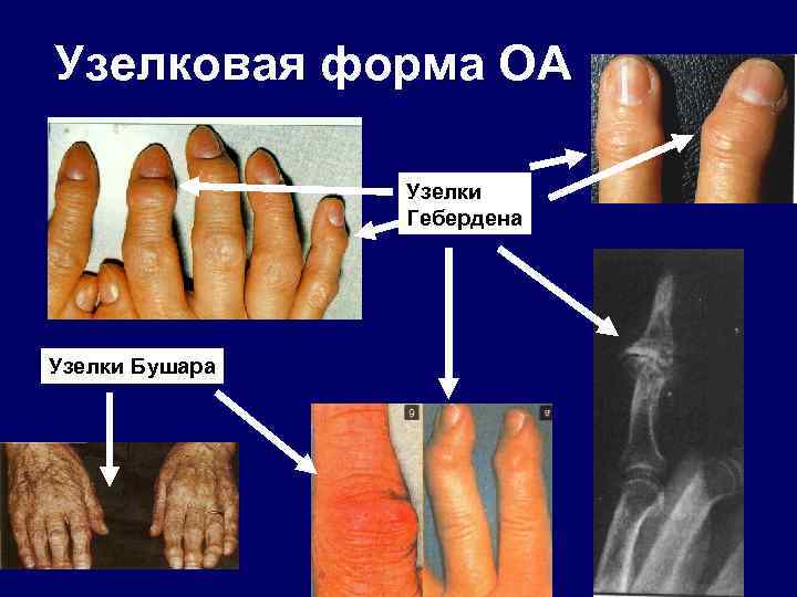 Узелковая форма ОА Узелки Гебердена Узелки Бушара 