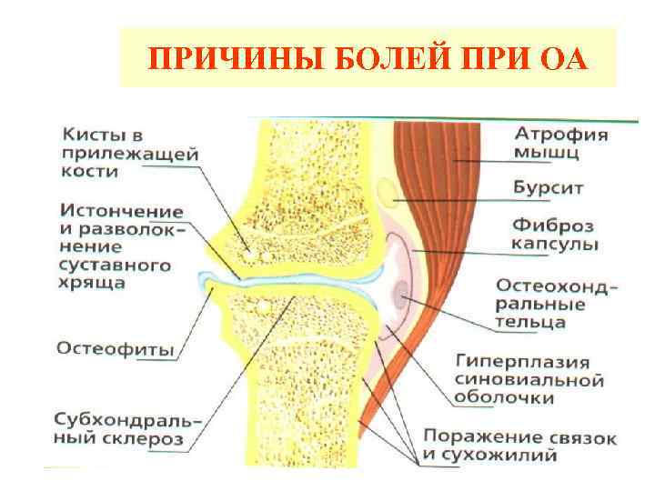 ПРИЧИНЫ БОЛЕЙ ПРИ ОА 