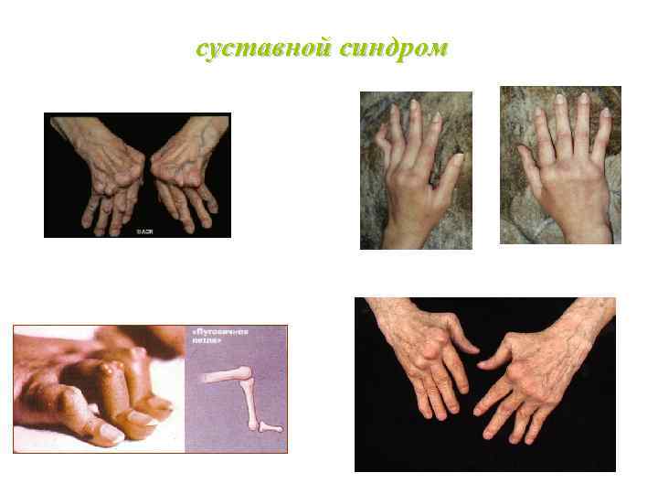 суставной синдром 