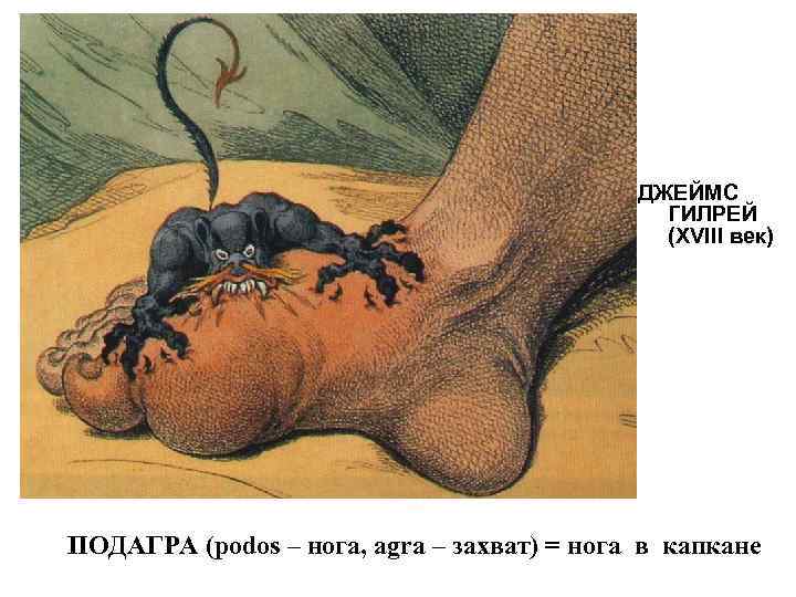ДЖЕЙМС ГИЛРЕЙ (XVIII век) ПОДАГРА (podos – нога, agra – захват) = нога в