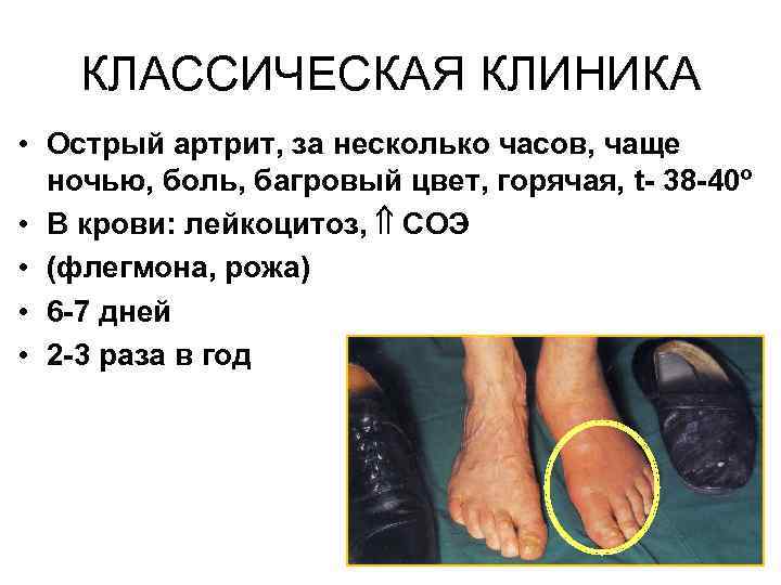 КЛАССИЧЕСКАЯ КЛИНИКА • Острый артрит, за несколько часов, чаще ночью, боль, багровый цвет, горячая,