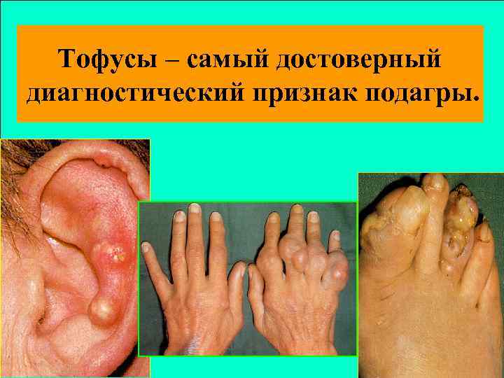 Тофусы – самый достоверный диагностический признак подагры. 