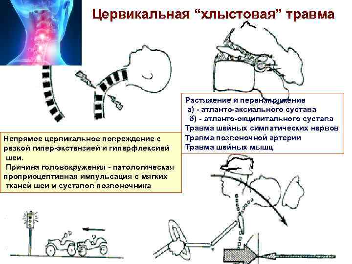 Цервикальная “хлыстовая” травма Непрямое цервикальное повреждение с резкой гипер-экстензией и гиперфлексией шеи. Причина головокружения