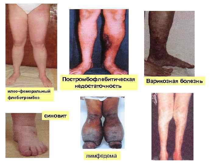 Постромбофлебитическая недостаточность илео-феморальный флеботромбоз синовит лимфедема Варикозная болезнь 