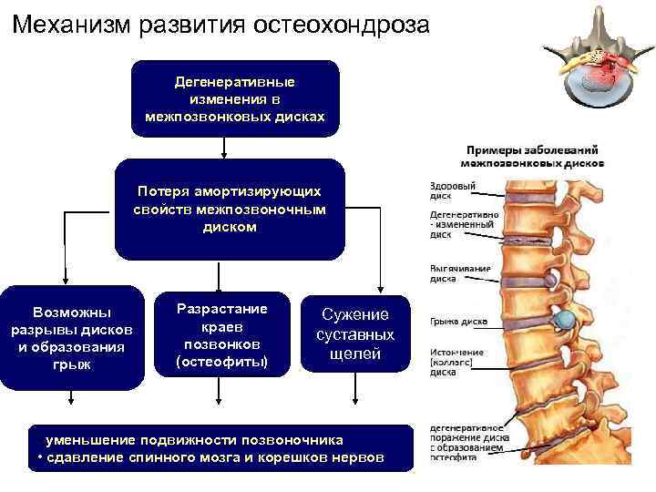 Механизм развития остеохондроза Дегенеративные изменения в межпозвонковых дисках Потеря амортизирующих свойств межпозвоночным диском Возможны