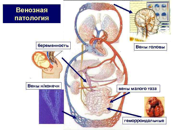 Венозная патология беременность Вены н/конечн Вены головы вены малого таза геморроидальные 