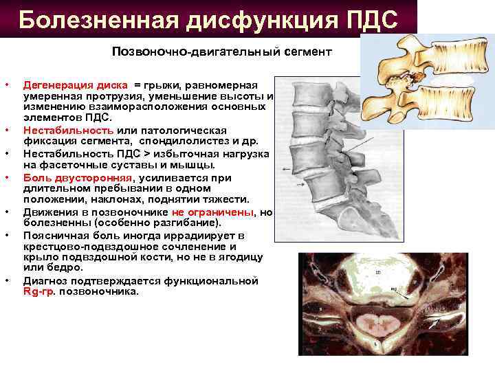 Болезненная дисфункция ПДС Позвоночно-двигательный сегмент • • Дегенерация диска = грыжи, равномерная умеренная протрузия,