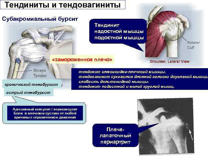 Парциальный разрыв. Тендинит сухожилия надостной. Тендовагинит сухожилия надостной мышцы плечевого сустава. Тендинит сухожилия ротаторной манжеты плечевого сустава. Субакромиальная Бурса.