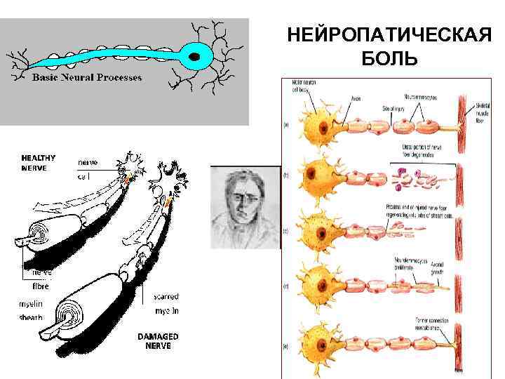 НЕЙРОПАТИЧЕСКАЯ БОЛЬ 