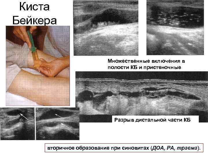 Киста Бейкера Множественные включения в полости КБ и пристеночные Разрыв дистальной части КБ вторичное