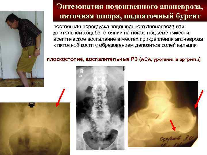 Энтезопатия подошвенного апоневроза, пяточная шпора, подпяточный бурсит постоянная перегрузка подошвенного апоневроза при: длительной ходьбе,