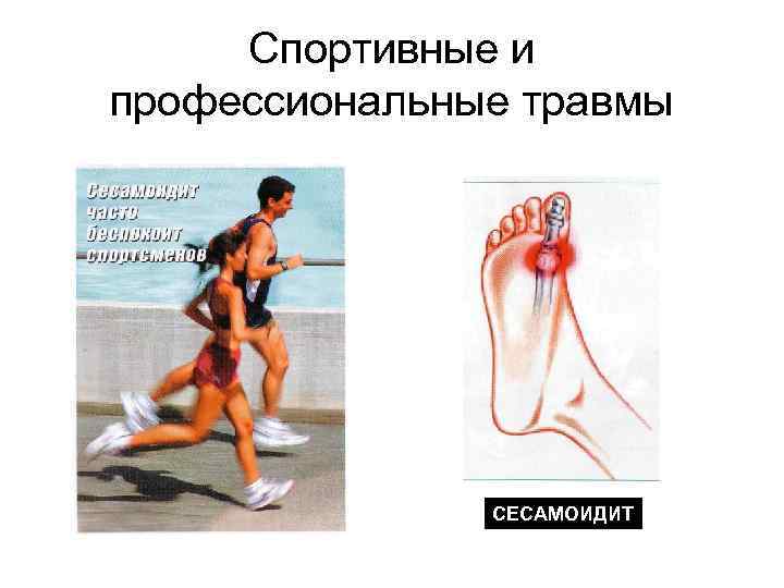 Спортивные и профессиональные травмы СЕСАМОИДИТ 