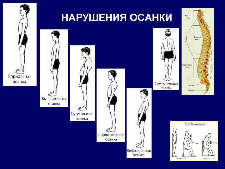 НАРУШЕНИЯ ОСАНКИ 