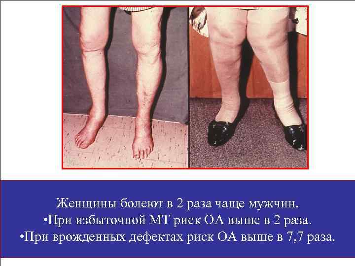 Женщины болеют в 2 раза чаще мужчин. • При избыточной МТ риск ОА выше