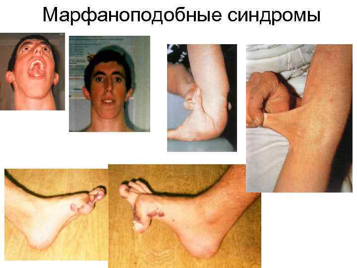Марфаноподобные синдромы 